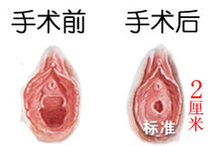 沈阳京科妇科医院2cm阴道紧缩术